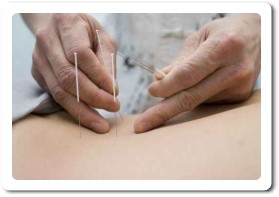 Akupunktur Anwendung
